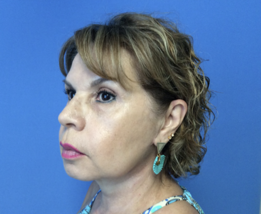 Lower-Face-and-Neck-Lift | After Face